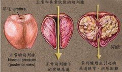 前列腺炎和前列腺腫大是一回事嗎？